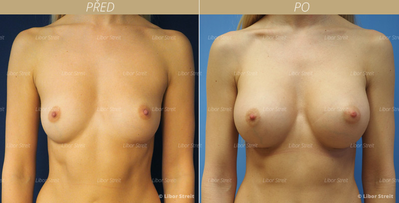 Zvětšení prsou silikonovými implantáty foto před a po (augmentace prsou)