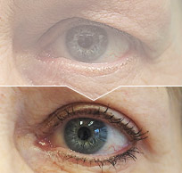 Plastická operace očních viček – blefaroplastika