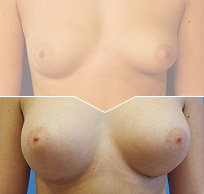 Kompozitní augmentace vlastním tukem a silikonovými implantáty foto před a po