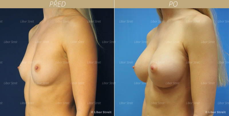 Kompozitní zvětšení prsou foto před a po (kompozitní augmentace prsou)