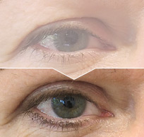 Plastická operace očních viček – foto před a po