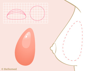 Ergonomické silikonové implantáty při augmentace prsou (zvětšení prsou).