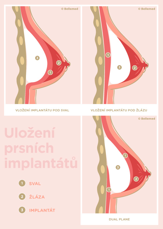 Vložení silikonového implantátu při zvětšení prsou (augmentace prsou).