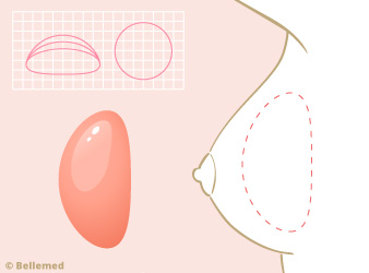 Kulatý silikonový implantát při augmentace prsou (zvětšení prsou).